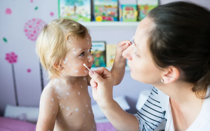 Xử lý thế nào nếu vô tình làm vỡ nốt phỏng khi tắm?