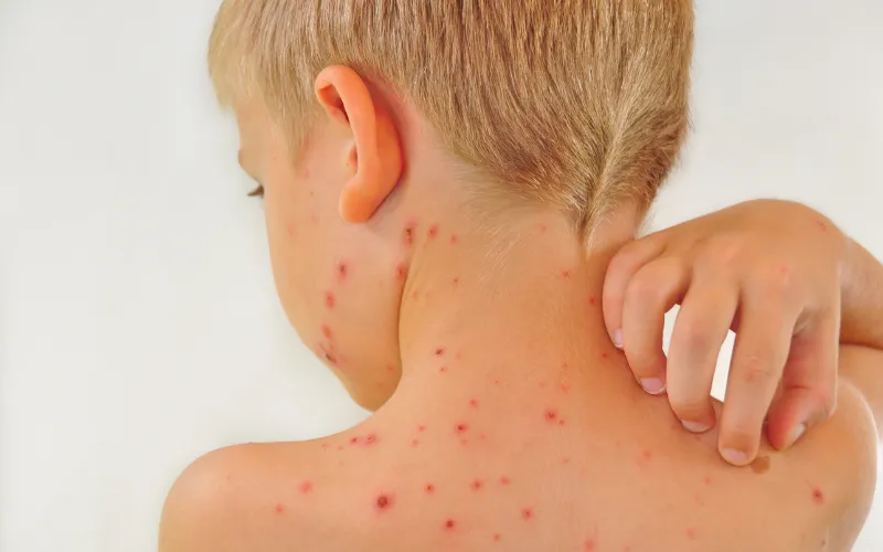 Trẻ bị thủy đậu có được tắm không?